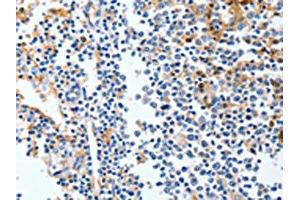 The image on the left is immunohistochemistry of paraffin-embedded Human tonsil tissue using ABIN7191316(LRP1 Antibody) at dilution 1/90, on the right is treated with synthetic peptide. (LRP1 antibody)