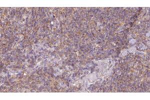 ABIN6273189 at 1/100 staining Human lymph cancer tissue by IHC-P. (ACAA1 antibody  (N-Term))