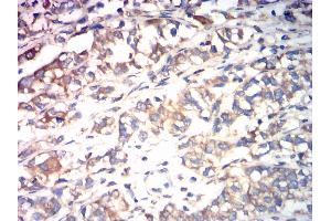 Immunohistochemical analysis of paraffin-embedded bladder cancer tissues using CALR mouse mAb with DAB staining. (Calreticulin antibody  (AA 18-417))