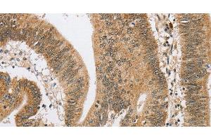 Immunohistochemistry of paraffin-embedded Human colon cancer using ARHGAP25 Polyclonal Antibody at dilution of 1:40 (ARHGAP25 antibody)