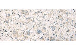 Immunohistochemistry of paraffin-embedded Human liver cancer tissue using SPSB2 Polyclonal Antibody at dilution of 1:70(x200) (SPSB2 antibody)