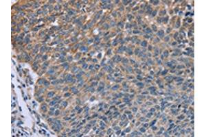The image on the left is immunohistochemistry of paraffin-embedded Human lung cancer tissue using ABIN7129622(GNAI3 Antibody) at dilution 1/30, on the right is treated with fusion protein. (GNAI3 antibody)