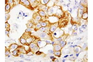 Anti-TNF Receptor II antibody, IHC(P) IHC(P): Human Mammary Cancer Tissue (TNFRSF1B antibody  (Middle Region))