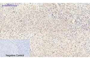 Immunohistochemical analysis of paraffin-embedded human uterus cancer tissue. (Connexin 43/GJA1 antibody  (AA 310-390))