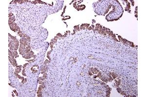 IHC-P Image GABA B Receptor 1 antibody [N2C1], Internal detects GABA B Receptor 1 protein at cytosol on human ovarian carcinoma by immunohistochemical analysis. (GABBR1 antibody)