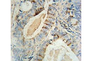 GCNT2 antibody immunohistochemistry analysis in formalin fixed and paraffin embedded human prostate carcinoma. (GCNT2 antibody  (AA 364-391))