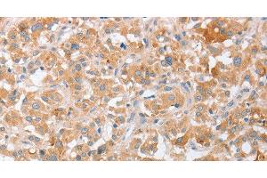 Immunohistochemistry of paraffin-embedded Human thyroid cancer tissue using SIGLEC9 Polyclonal Antibody at dilution 1:40 (SIGLEC9 antibody)