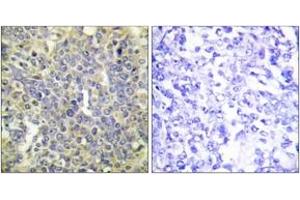 Immunohistochemistry analysis of paraffin-embedded human lung carcinoma, using Caspase 9 (Phospho-Thr125) Antibody.