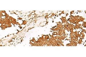 Immunohistochemistry of paraffin-embedded Human lung cancer tissue using HUS1 Polyclonal Antibody at dilution of 1:65(x200) (HUS1 antibody)