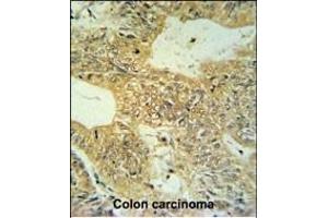 CLDN23 Antibody (C-term) (ABIN653789 and ABIN2843074) IHC analysis in formalin fixed and paraffin embedded colon carcinoma followed by peroxidase conjugation of the secondary antibody and DAB staining.