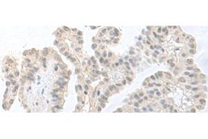 Immunohistochemistry of paraffin-embedded Human thyroid cancer tissue using RPS27L Polyclonal Antibody at dilution of 1:55(x200) (RPS27L antibody)