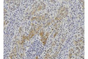ABIN6276395 at 1/100 staining Human lung cancer tissue by IHC-P. (Endothelin 1 antibody  (C-Term))