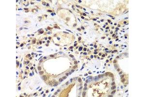 Immunohistochemistry of paraffin-embedded Human gastric cancer using PSME2 Polyclonal Antibody at dilution of 1:100 (40x lens). (PSME2 antibody)
