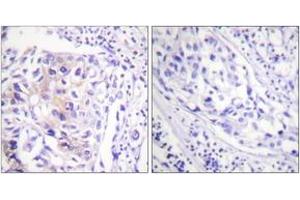 Immunohistochemistry analysis of paraffin-embedded human breast carcinoma, using CBL (Phospho-Tyr774) Antibody. (CBL antibody  (pTyr774))
