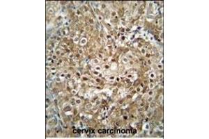 C antibody (C-term) (ABIN654740 and ABIN2844426) immunohistochemistry analysis in formalin fixed and paraffin embedded human cervix carcinoma followed by peroxidase conjugation of the secondary antibody and DAB staining. (CF153 (AA 230-259), (C-Term) antibody)