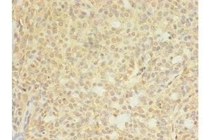 Immunohistochemistry of paraffin-embedded human breast cancer using ABIN7148714 at dilution of 1:100 (CTP Synthase antibody  (AA 300-554))
