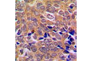 Immunohistochemical analysis of ABL1/2 staining in human breast cancer formalin fixed paraffin embedded tissue section.