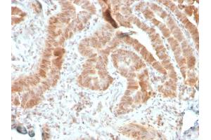 Formalin-fixed, paraffin-embedded human colon carcinoma stained with AKT1 Recombinant Mouse Monoclonal Antibody (rAKT1/2491). (Recombinant AKT1 antibody  (AA 85-189))