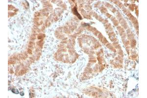 Formalin-fixed, paraffin-embedded human colon carcinoma stained with AKT1 Recombinant Mouse Monoclonal Antibody (rAKT1/2491). (Recombinant AKT1 antibody  (AA 85-189))