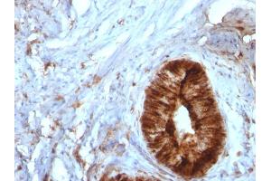 Formalin-fixed, paraffin-embedded human Cervical Carcinoma stained with Beta-2-Microglobulin Mouse Monoclonal Antibody (B/961). (beta-2 Microglobulin antibody)