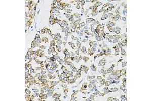 Immunohistochemistry of paraffin-embedded human esophageal cancer using PPP1CA antibody (ABIN6290760) at dilution of 1:100 (40x lens).