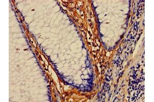 Immunohistochemistry of paraffin-embedded human colon cancer using ABIN7160053 at dilution of 1:100 (MAP3K7 antibody  (AA 101-400))