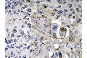 Immunohistochemistry analyzes of PDGF-A antibody in paraffin-embedded human lung carcinoma tissue. (PDGFA antibody)