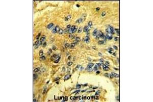 Formalin-fixed and paraffin-embedded human lung carcinoma reacted with CDK3 Antibody (N-term Y19), which was peroxidase-conjugated to the secondary antibody, followed by DAB staining. (CDK3 antibody  (N-Term))