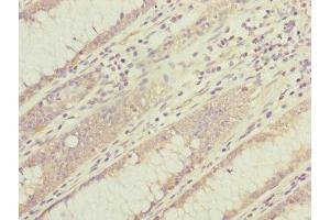 Immunohistochemistry of paraffin-embedded human colon cancer using ABIN7149316 at dilution of 1:100