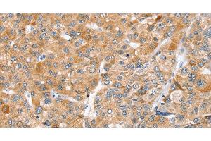 Immunohistochemistry of paraffin-embedded Human liver cancer using ZFP36L2 Polyclonal Antibody at dilution of 1:45 (ZFP36L2 antibody)