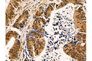 ABIN6258686 and ABIN6274922 at 1/100 staining Human colorectal cancer by IHC-P. (FAM203B antibody  (Internal Region))