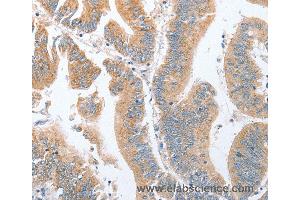 Immunohistochemistry of Human breast cancer using PARD6A Polyclonal Antibody at dilution of 1:60 (PARD6A antibody)