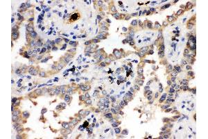 Anti- ULK3 Picoband antibody, IHC(P) IHC(P): Human Lung Cancer Tissue (ULK3 antibody  (C-Term))