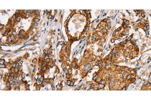 Immunohistochemistry of paraffin-embedded Human liver cancer tissue using SLC5A11 Polyclonal Antibody at dilution 1:35 (Solute Carrier Family 5 (Sodium/inositol Cotransporter), Member 11 (SLC5A11) antibody)