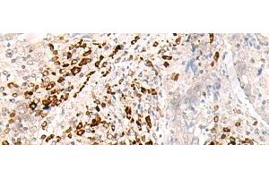 Immunohistochemistry of paraffin-embedded Human cervical cancer tissue using HLA-B Polyclonal Antibody at dilution of 1:30(x200) (HLA-B antibody)