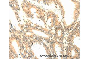 Immunohistochemistry of Human colon cancer using PTGES3 Polyclonal Antibody at dilution of 1:50 (CDK5R1 antibody)