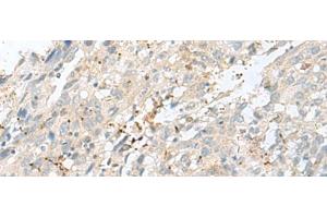 Immunohistochemistry of paraffin-embedded Human cervical cancer tissue using TPMT Polyclonal Antibody at dilution of 1:60(x200) (TPMT antibody)