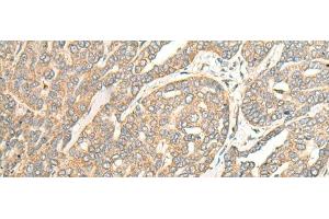 Immunohistochemistry of paraffin-embedded Human liver cancer tissue using ITM2B Polyclonal Antibody at dilution of 1:35(x200) (ITM2B antibody)