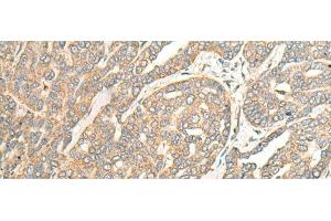 Immunohistochemistry of paraffin-embedded Human liver cancer tissue using ITM2B Polyclonal Antibody at dilution of 1:35(x200)