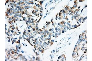 Immunohistochemical staining of paraffin-embedded Adenocarcinoma of Human colon tissue using anti-IGF2BP2 mouse monoclonal antibody. (IGF2BP2 antibody)