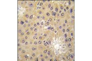 Formalin-fixed and paraffin-embedded human hepatocarcinoma tissue reacted with ACAT1 antibody (C-term), which was peroxidase-conjugated to the secondary antibody, followed by DAB staining. (ACAT1 antibody  (C-Term))