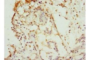 Immunohistochemistry of paraffin-embedded human breast cancer using ABIN7146875 at dilution of 1:100 (CSNK1G1 antibody  (Isoform gamma 1))