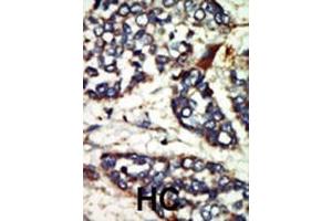 Formalin-fixed and paraffin-embedded human cancer tissue reacted with the primary antibody, which was peroxidase-conjugated to the secondary antibody, followed by DAB staining. (NEK1 antibody  (C-Term))