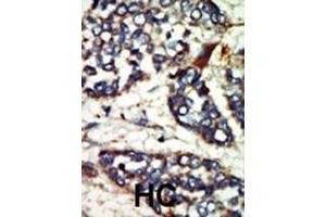 Formalin-fixed and paraffin-embedded human cancer tissue reacted with the primary antibody, which was peroxidase-conjugated to the secondary antibody, followed by DAB staining. (NEK1 antibody  (C-Term))