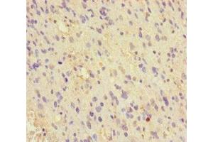Immunohistochemistry of paraffin-embedded human glioma using ABIN7159738 at dilution of 1:100 (MCRS1 antibody  (AA 1-138))