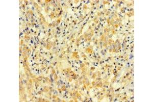Immunohistochemistry of paraffin-embedded human lung cancer using ABIN7167948 at dilution of 1:100 (ARHGAP27 antibody  (AA 1-300))