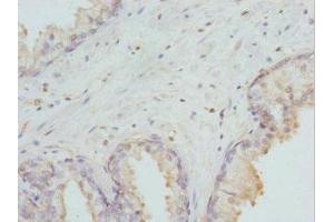 Immunohistochemistry of paraffin-embedded human prostate cancer using ABIN7155677 at dilution of 1:100 (DLX2 antibody  (AA 1-140))