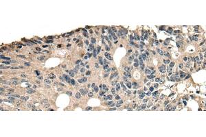 Immunohistochemistry of paraffin-embedded Human colorectal cancer tissue using SLAMF7 Polyclonal Antibody at dilution of 1:30(x200) (SLAMF7 antibody)