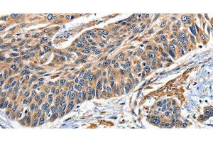 Immunohistochemistry of paraffin-embedded Human esophagus cancer tissue using EFNB2 Polyclonal Antibody at dilution 1:80 (Ephrin B2 antibody)