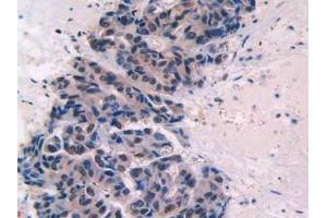 IHC-P analysis of Human Breast Cancer Tissue, with DAB staining.